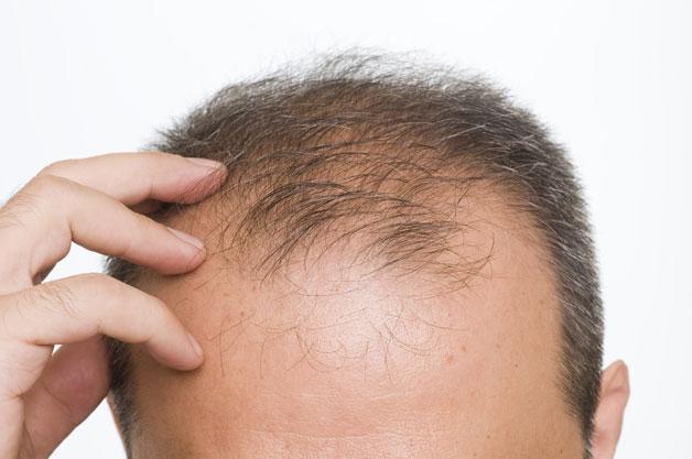 Triệu chứng, nguyên nhân và cách điều trị rụng tóc ở nam giới