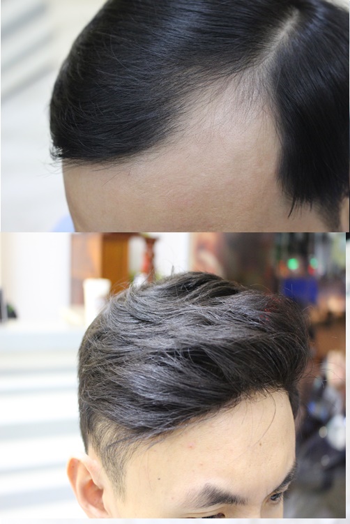 5 kiểu tóc cho người hói chữ M  Giải cứu nhược điểm hói đầu tức thì