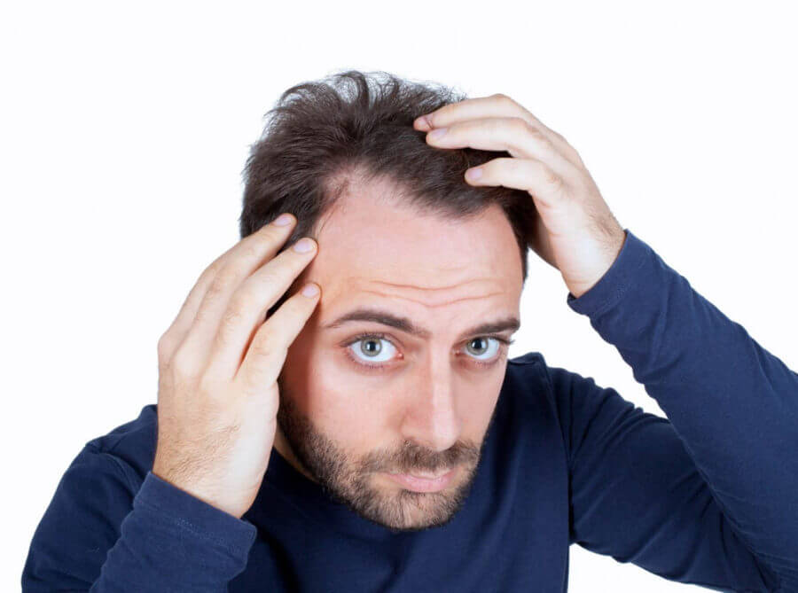 Rụng tóc từng mảng là bệnh gì Nguyên nhân dấu hiệu cách chữa trị